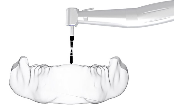 All-On-Four Surgical Protocol