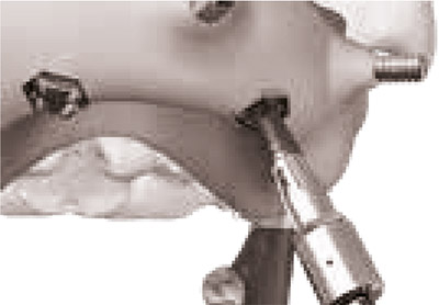 implant-yerlestirilmesi