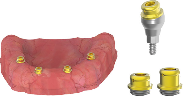 locator-abutment-kapali-kasik