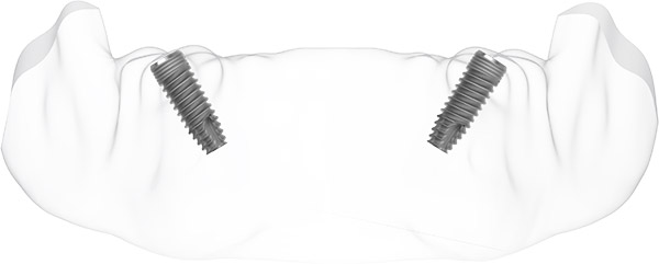 posterior-implantasyon