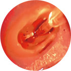 oral-photodynamic-therapy-12