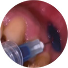 oral-photodynamic-therapy-13
