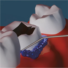 oral-photodynamic-therapy-16