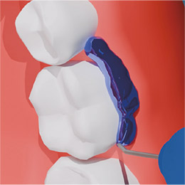 oral-photodynamic-therapy-17