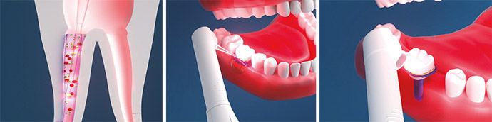 oral-photodynamic-therapy-2